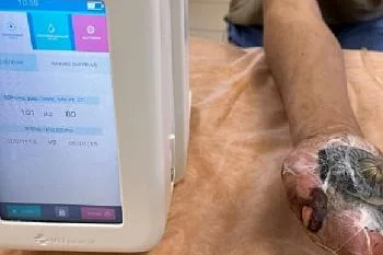 В хирургическом отделении № 4 Центральной городской клинической больницы активно используются передовые технологии для лечения ран